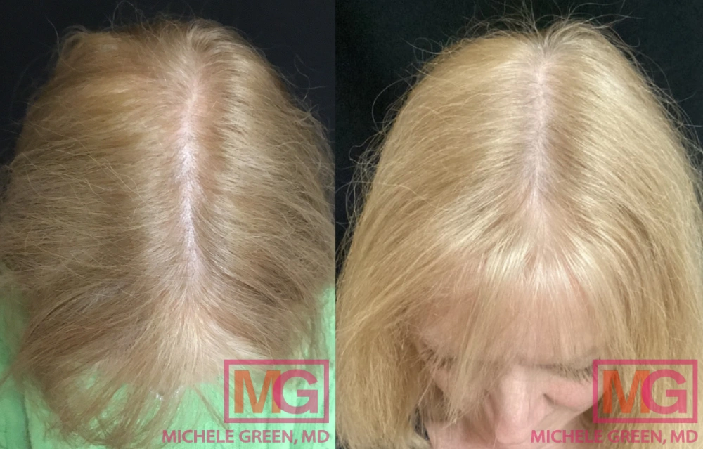 Before and after images showing improved hair density in a woman following PRP treatment for female pattern baldness.